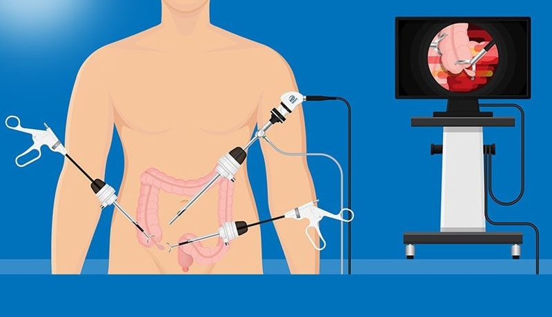 Sau mổ ruột thừa kiêng ăn gì và nên ăn gì để mau lành? 1