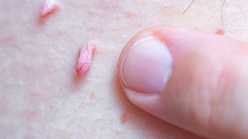 Đặc điểm điển hình của sùi mào gà là tổn thương không gây cảm giác khó chịu