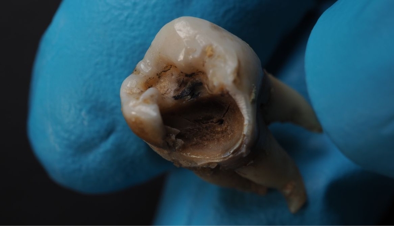 Sâu răng ở người lớn: Nhận biết sớm và cách xử lý kịp thời 1