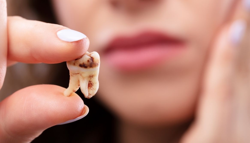 Sâu răng ở người lớn: Nhận biết sớm và cách xử lý kịp thời 2