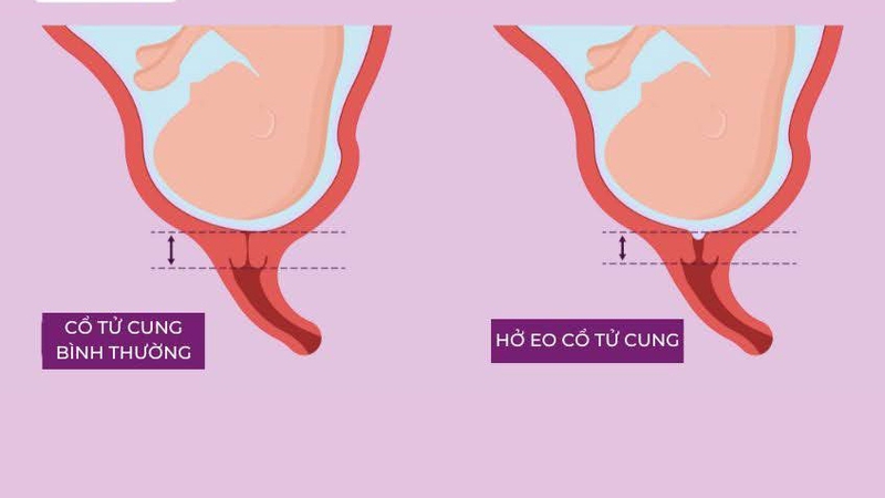 Sau sảy thai có thể ăn chua không? 2