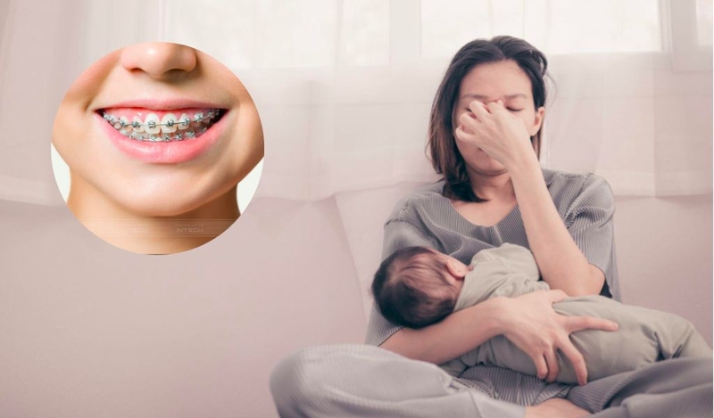 Sau sinh bao lâu thì niềng răng được? Lưu ý trước khi niềng răng sau sinh? 1