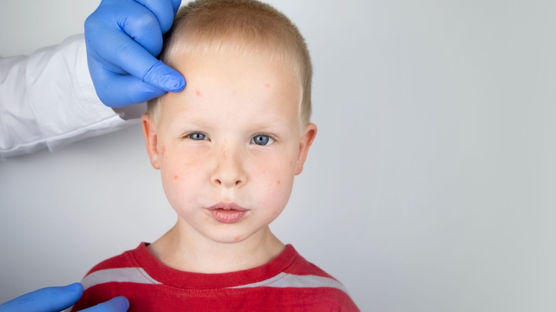 Sau tiêm vắc-xin bị sưng mắt phải làm sao? Cách xử trí hiệu quả giúp giảm khó chịu vùng mắt 1