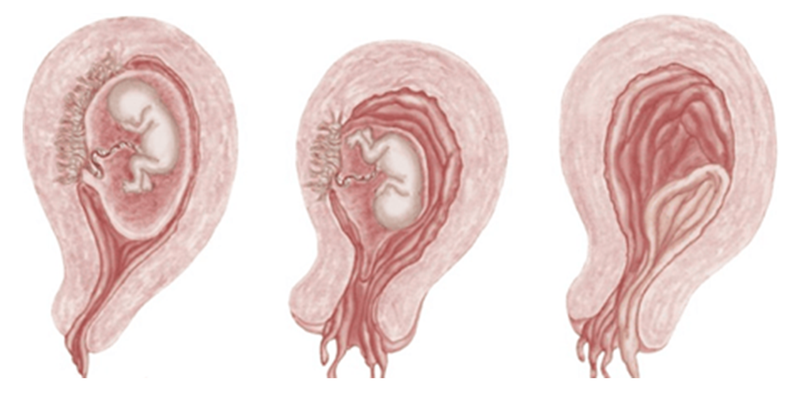 Sảy thai và thai lưu có giống nhau không? 1