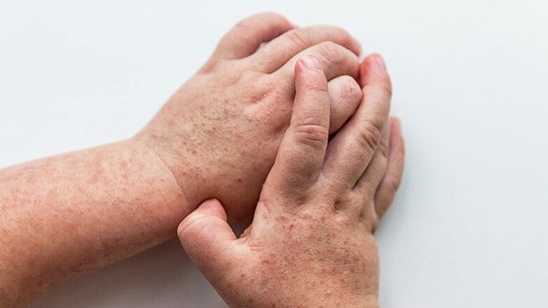 Scarlet fever là gì? Nguyên nhân, triệu chứng, chẩn đoán và điều trị Scarlet fever 2