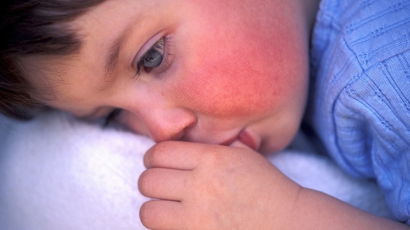 Scarlet fever là gì? Nguyên nhân, triệu chứng, chẩn đoán và điều trị Scarlet fever 4
