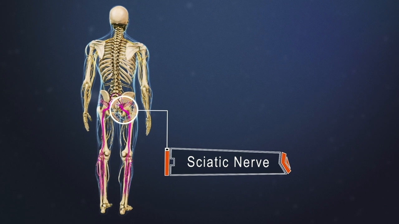 Sciatic nerve là gì? Nguyên nhân, triệu chứng và các phương pháp điều trị 1