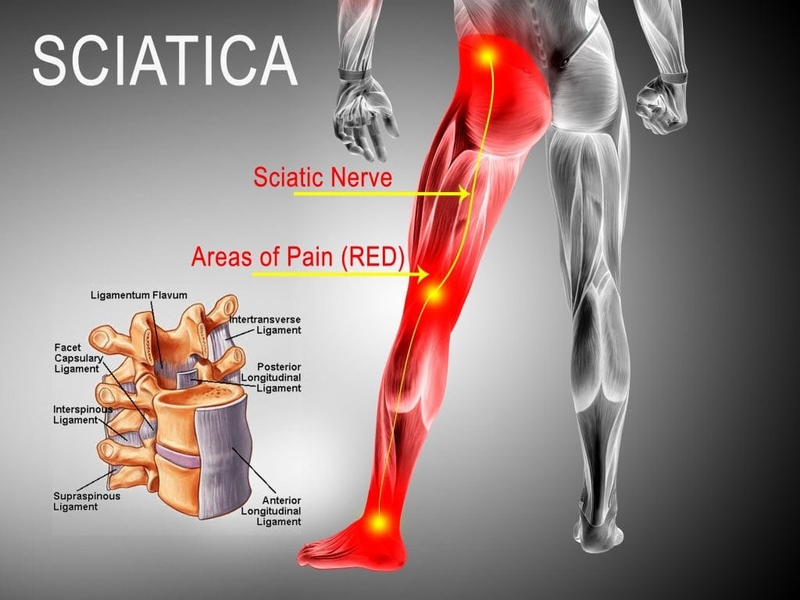 Sciatic nerve là gì? Nguyên nhân, triệu chứng và các phương pháp điều trị 2