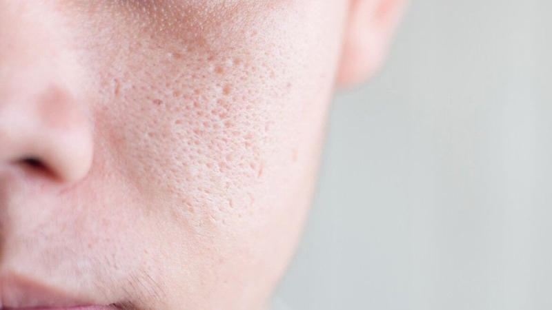 Mẹo se khít lỗ chân lông cho nam giới không thể bỏ qua 1