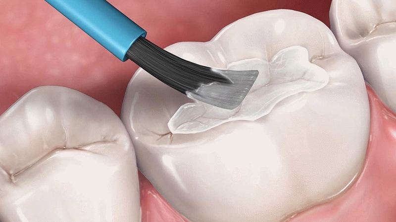 Sealant là gì? Phương pháp thực hiện và những ưu điểm 1