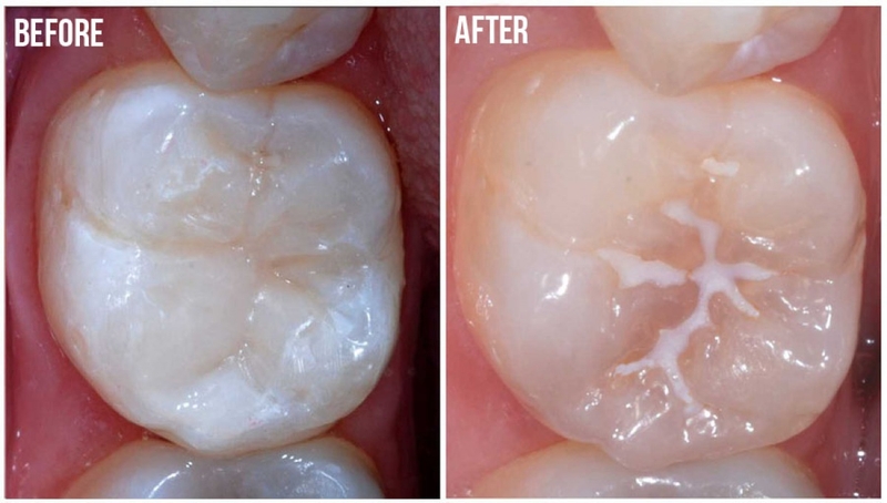 Sealant là gì? Phương pháp thực hiện và những ưu điểm 3