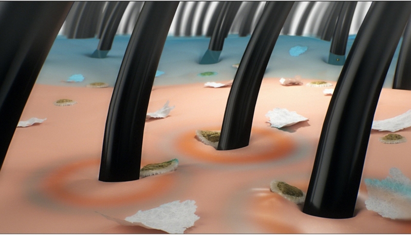 Cách trị gàu hiệu quả cho nam và một số lưu ý 1