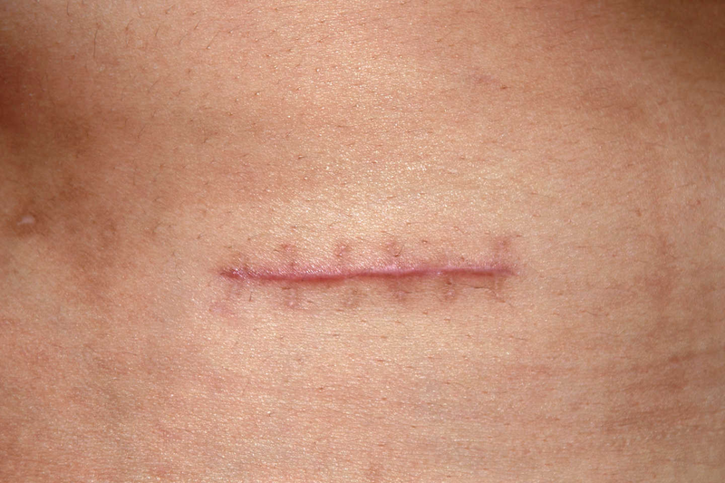 Những thay đổi trong cuộc sống sau khi điều trị ung thư 1