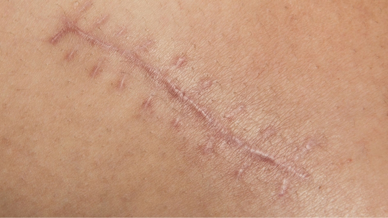 Sẹo bao lâu thì mờ là vấn đề được nhiều độc giả quan tâm