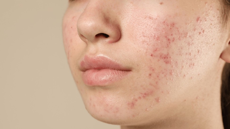 Tiêm chất làm đầy có thể khắc phục sẹo rỗ nhưng chỉ mang tính tạm thời
