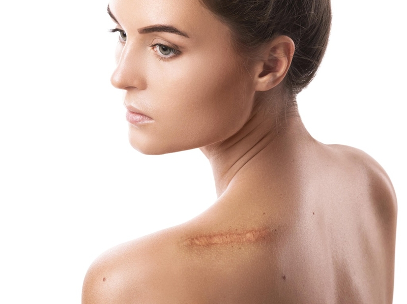 Cùng tìm hiểu bị sẹo lồi ăn gì? 1