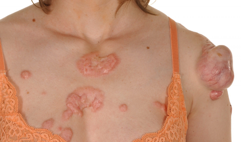 Sẹo lồi ăn tôm có được không? 2