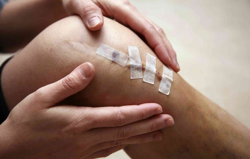 sẹo lồi có mủ 2