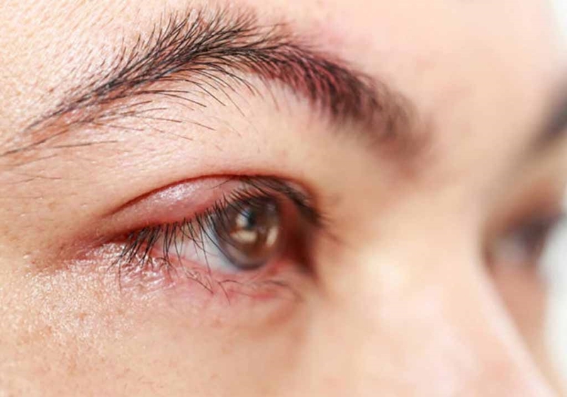 Sẹo lồi góc mắt: Những lưu ý và cách điều trị 1