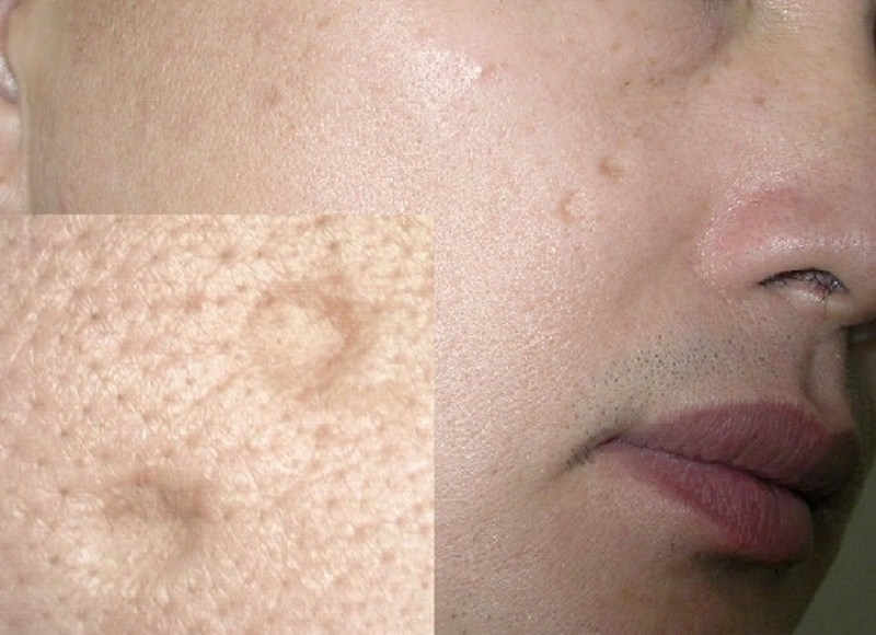 Sẹo lồi và sẹo lõm: Những điều cần biết 2