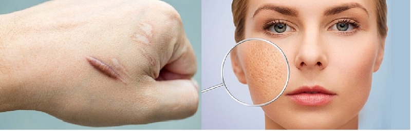 Sẹo lồi và sẹo lõm: Những điều cần biết 3