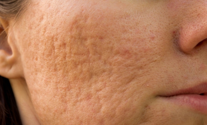 sẹo lõm có tự đầy không 1