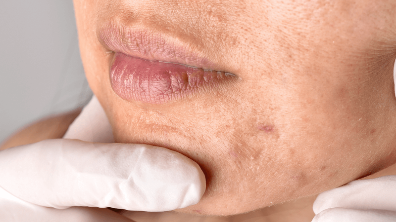 Sẹo lõm lâu năm có trị được không? Tìm hiểu khả năng cải thiện sẹo lâu năm