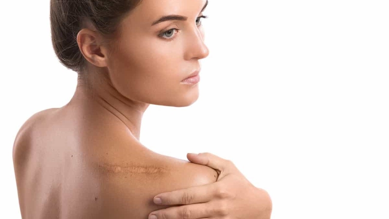 Phân biệt sẹo rỗ và sẹo lõm và cách điều trị chúng hợp lý 4