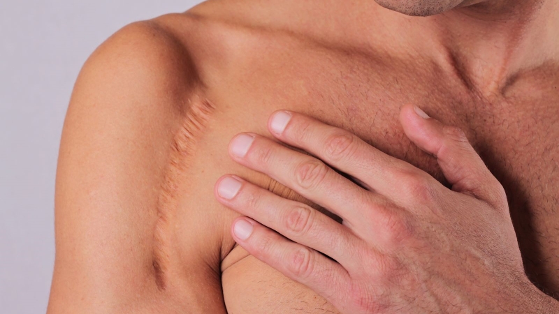 Sẹo lõm tai nạn: Điều trị thế nào cho phù hợp? 1