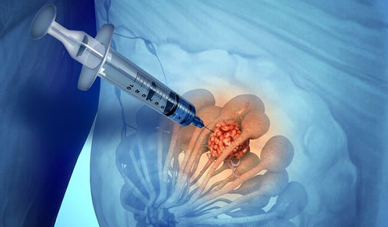 Sinh thiết mô tuyến vú