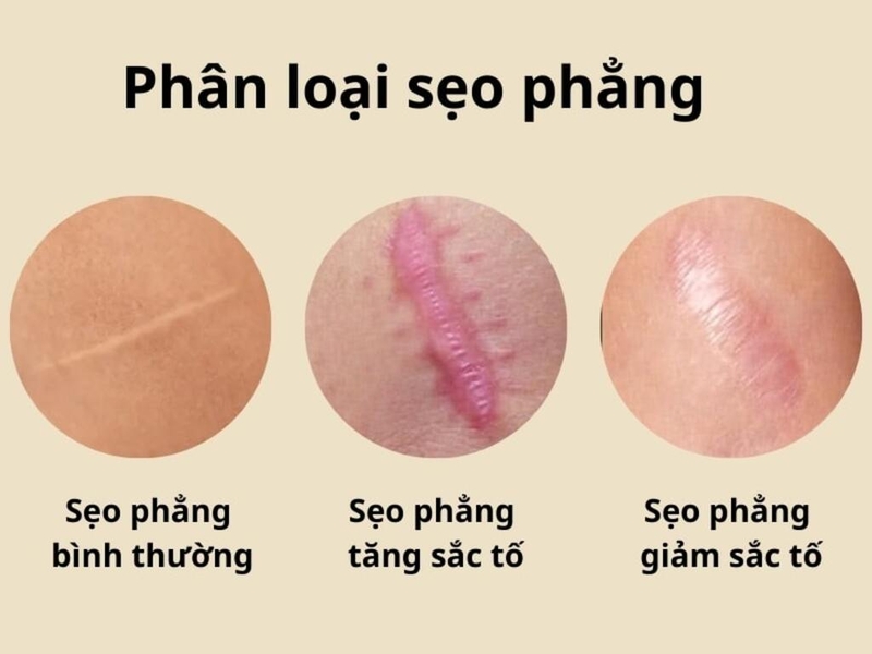 seo-phang-nguyen-nhan-va-cach-dieu-tri-seo-phang 1.jpg