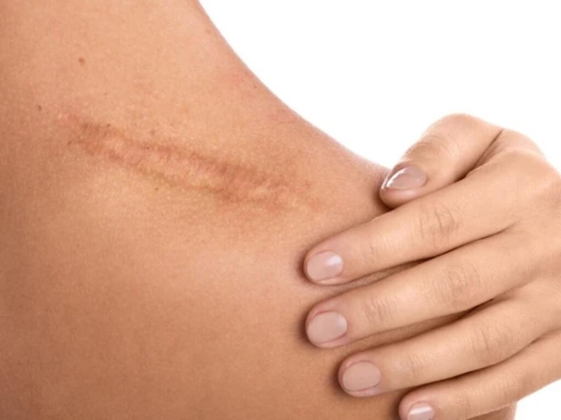 seo-phang-nguyen-nhan-va-cach-dieu-tri-seo-phang 2.jpg