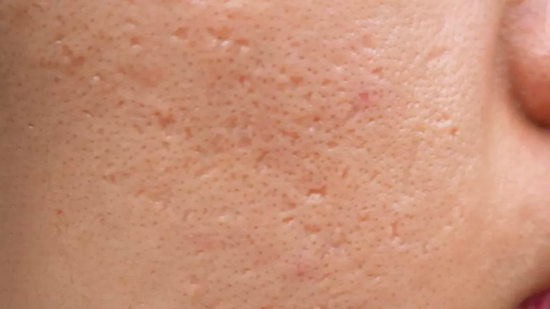 Sẹo rỗ là gì? Nguyên nhân, triệu chứng và cách điều trị 4