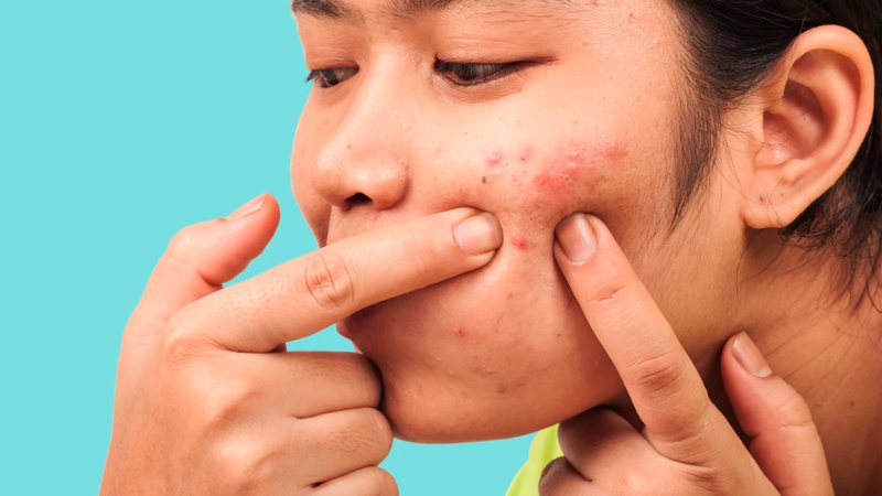 Sẹo rỗ là gì? Nguyên nhân, triệu chứng và cách điều trị 5