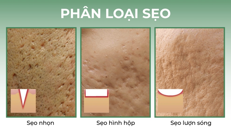 Sẹo rỗ đáy nhọn: Nguyên nhân và cách điều trị 1