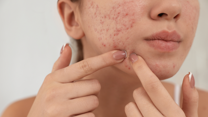 Mụn trứng cá nặng có thể phá hủy collagen dưới da và gây sẹo rỗ đáy vuông