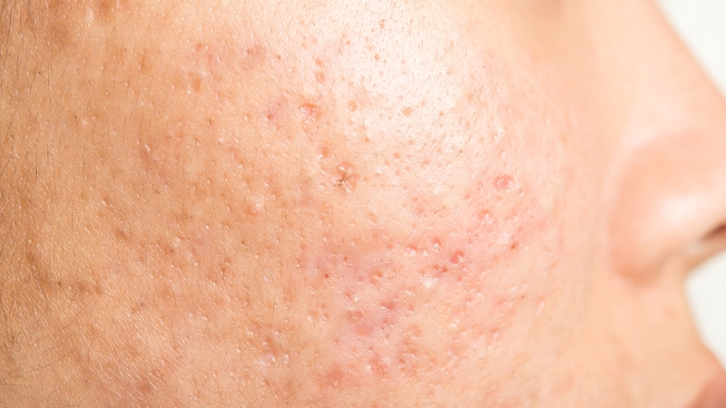 Trả lời cho câu hỏi sẹo rỗ nhẹ có hết không