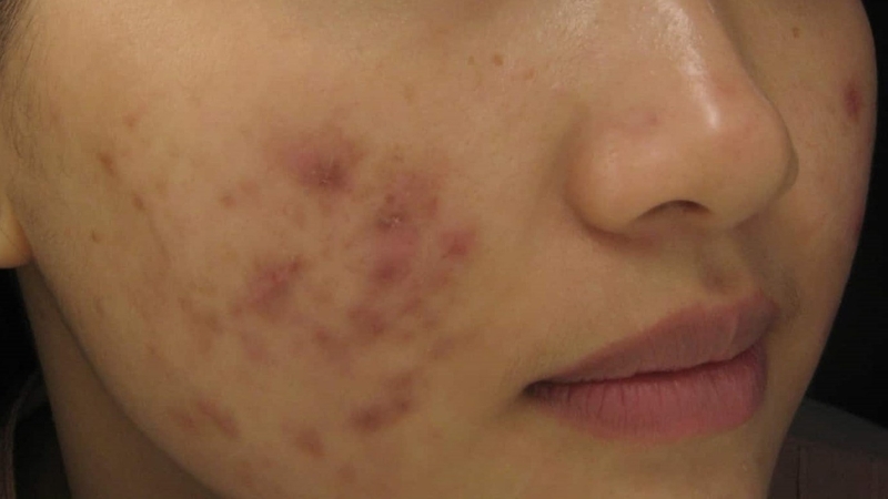 Sẹo thâm là gì? Cách làm mờ sẹo thâm hiệu quả 3