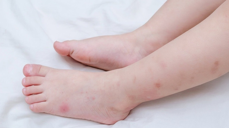 Sẹo thâm ở chân là gì? Làm mờ sẹo thâm ở chân