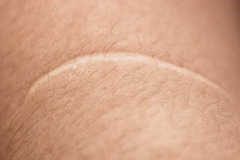 Sẹo trắng là gì? Phòng ngừa sẹo như thế nào? 2