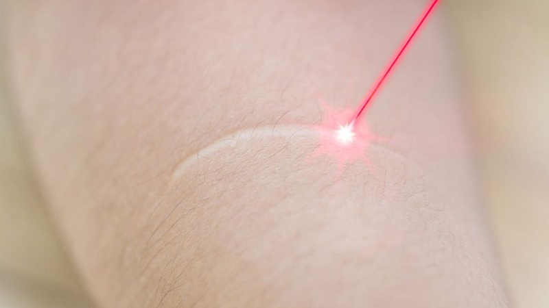 Sẹo trắng là gì? Phòng ngừa sẹo như thế nào? 3