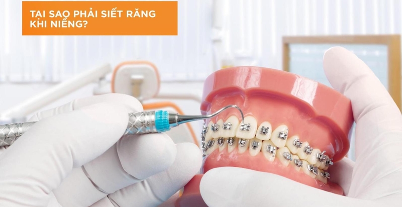 Siết răng khi niềng là gì? Niềng răng bao lâu siết một lần? 1