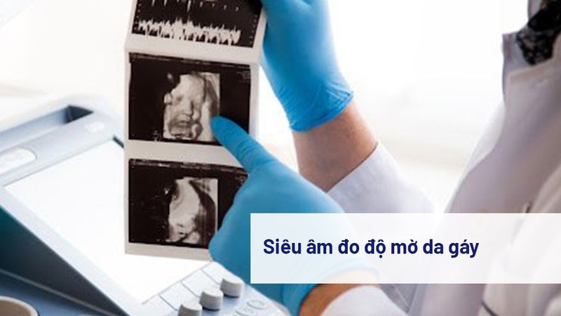 Siêu âm 2D có đo được độ mờ da gáy không? Có chính xác không? 1