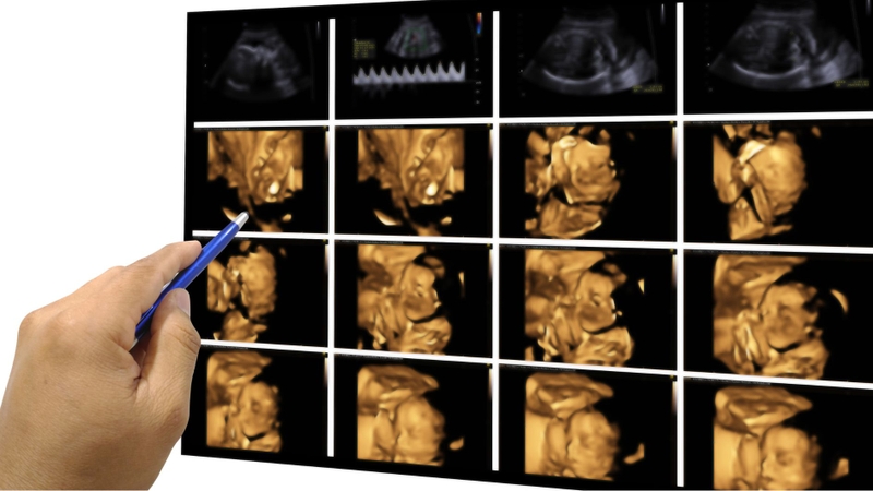 Siêu âm 4D hỗ trợ phát hiện sớm những dị tật thai nhi