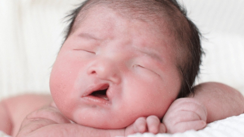 Siêu âm 4D là gì? Siêu âm 4D bị sứt môi phải làm gì? 3