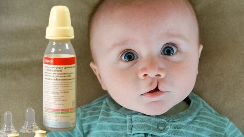 Siêu âm 4D là gì? Siêu âm 4D bị sứt môi phải làm gì? 4