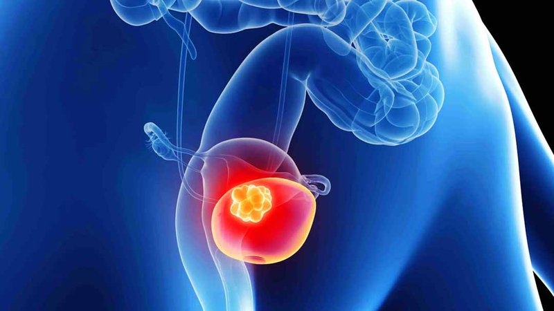 Siêu âm bàng quang hỗ trợ chẩn đoán bệnh lý nào? 2