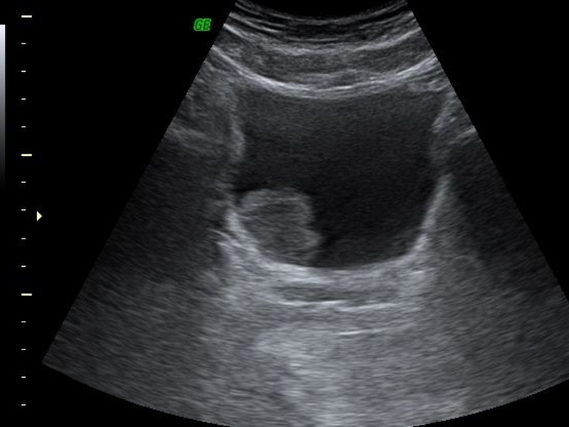 Siêu âm bàng quang hỗ trợ chẩn đoán bệnh lý nào? 3