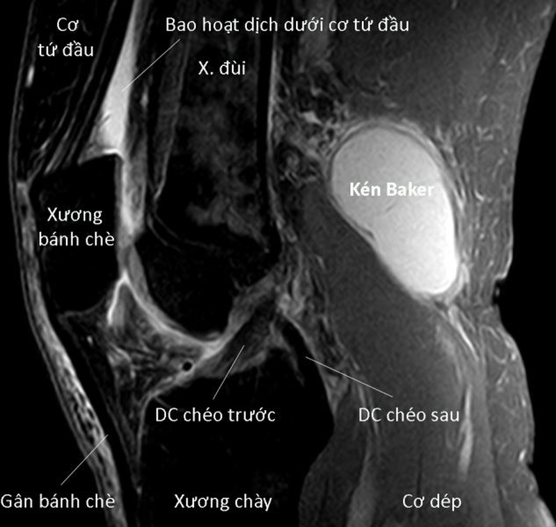 Siêu âm khớp gối giúp phát hiện các tổn thương nào? 2