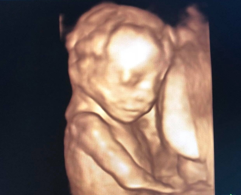 Siêu âm thai nhi 19 tuần tuổi cho thấy gì? 2